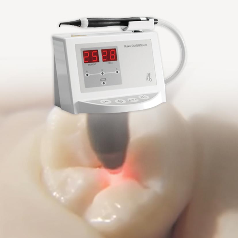 Dental-Hygiene-Services-DIAGNOdent-Laser-Cavity-Detection