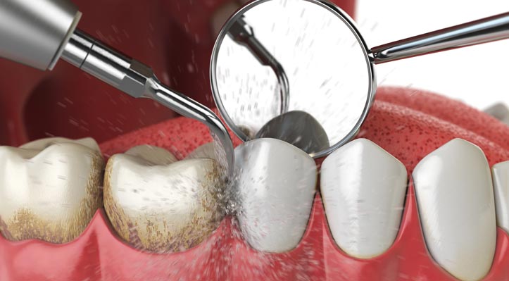 Dental-Hygiene-Services-Professional-Cleaning