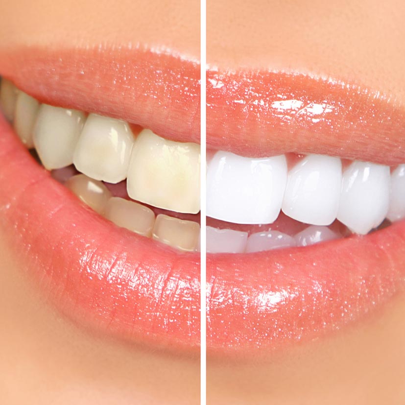 Dental-Hygiene-Services-Professional-Teeth-Whitening